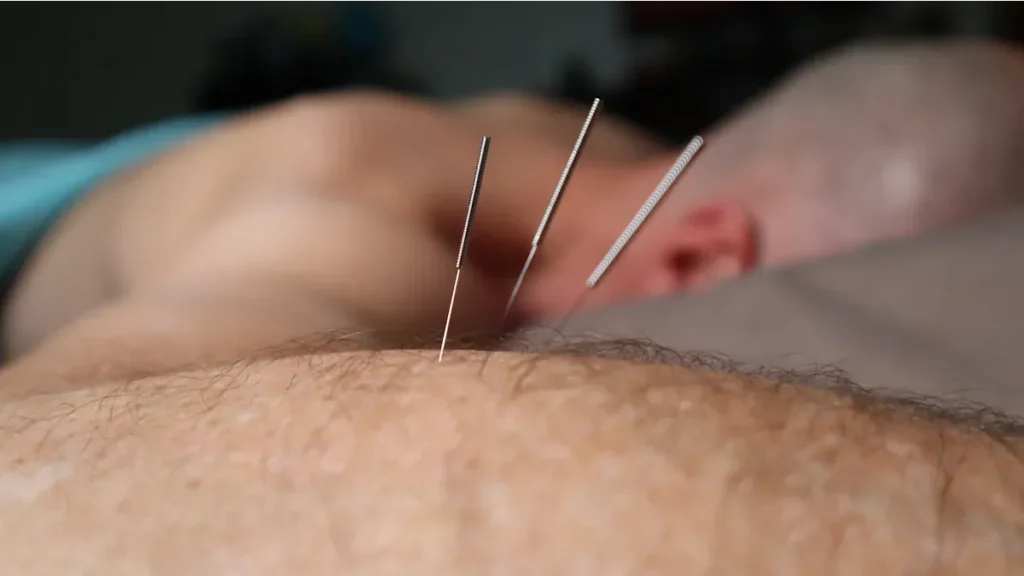 Fordele ved akupunktur