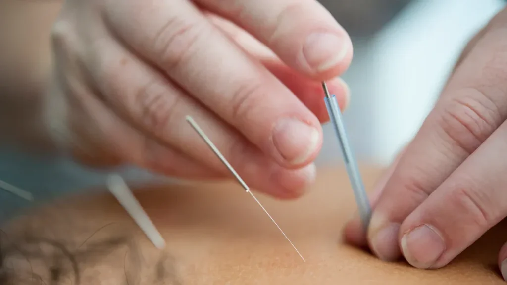 kinesisk Akupunktur Priser