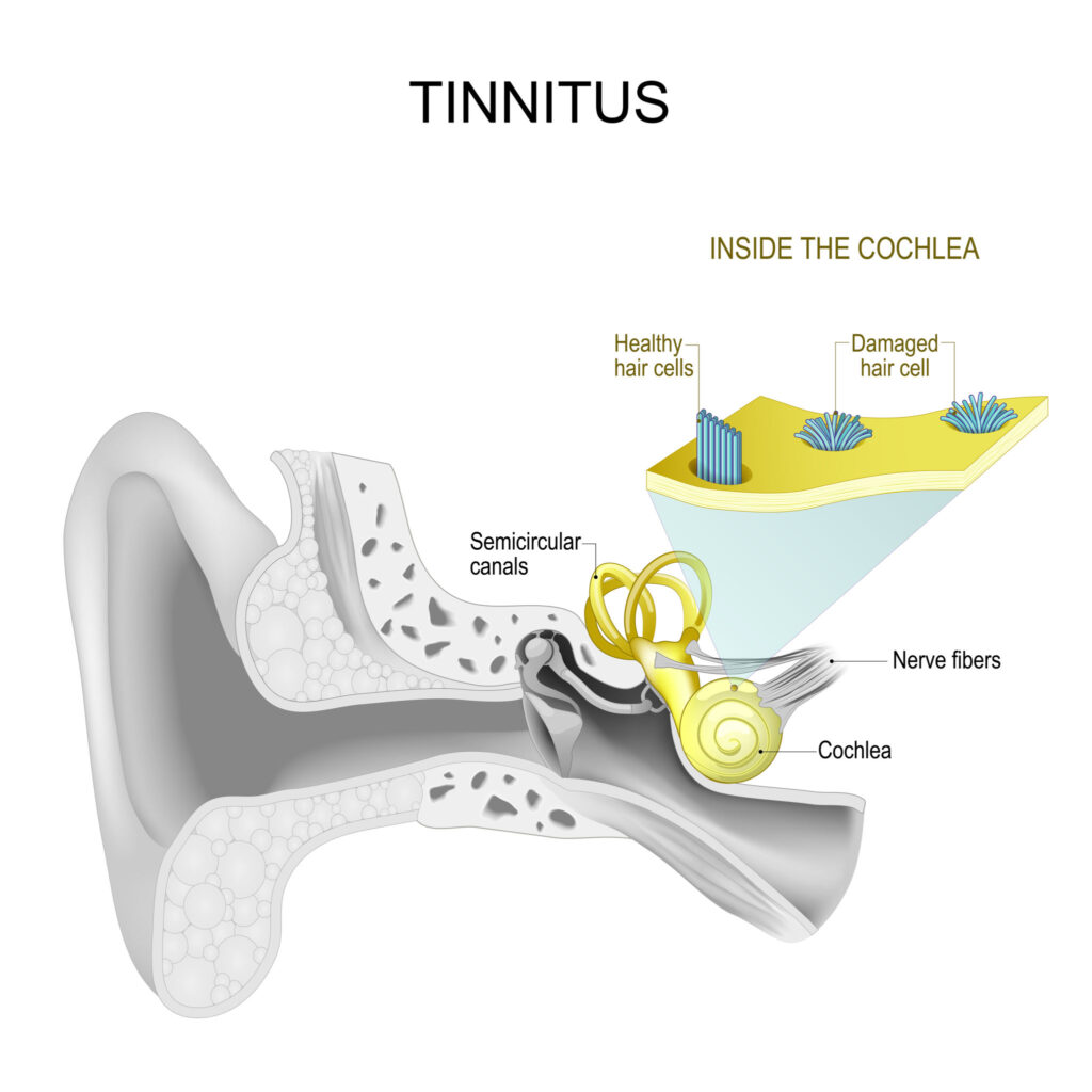 tinnitus treatment acupuncture Frederiksberg