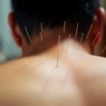 Akupunktur nåle placeret på ryg under behandling i akupunkturcenter Danmark