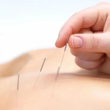 Akupunktur behandling i klinik i Frederiksberg med fokus på traditionel kinesisk medicin