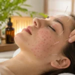 Young woman with hormonal acne and facial inflammation in a clean dermatology and acupuncture treatment environment